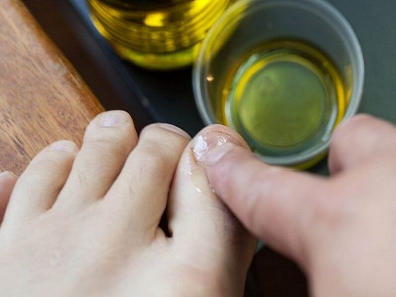 Tea tree oil against toenail fungus