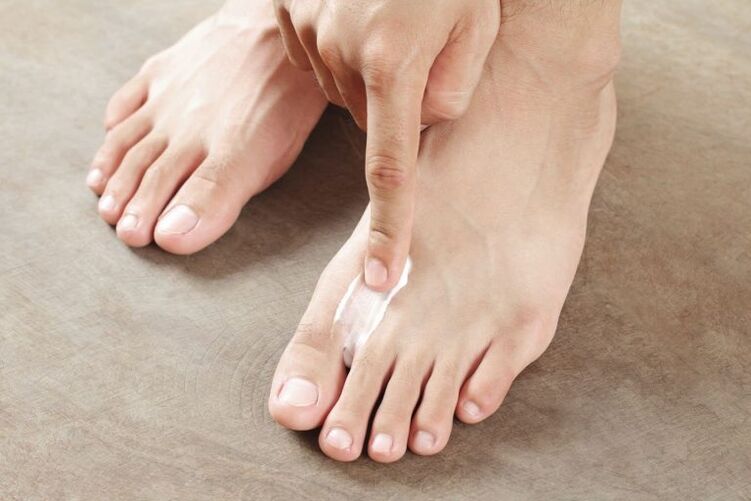 Application of antifungals to the skin of the foot