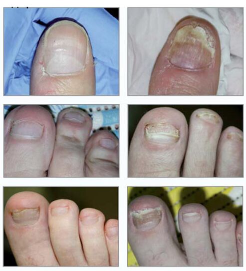 Types of nail fungus
