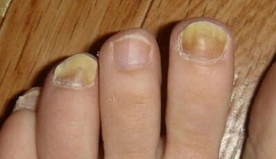 The causes of the appearance of the mushroom on the nails
