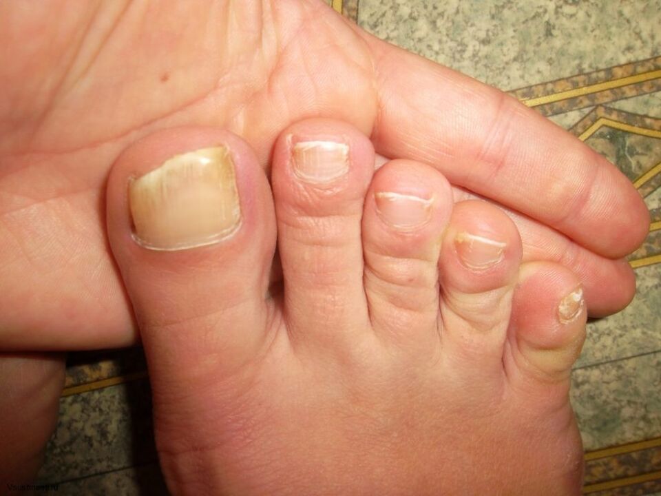 Yellowing of the nails with fungus
