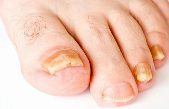 Forms of nail fungus