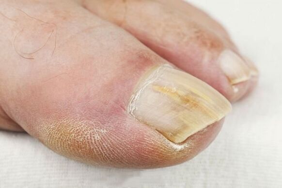 The consequences of mushroom lesions