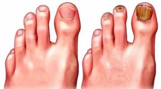 healthy and fungal nails