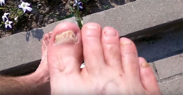 Toenail fungus