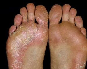 Lesion of the feet with fungus