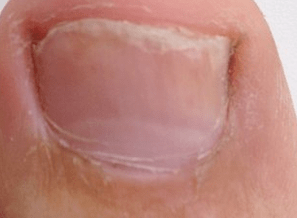Photo of the initial stages of toenail fungus
