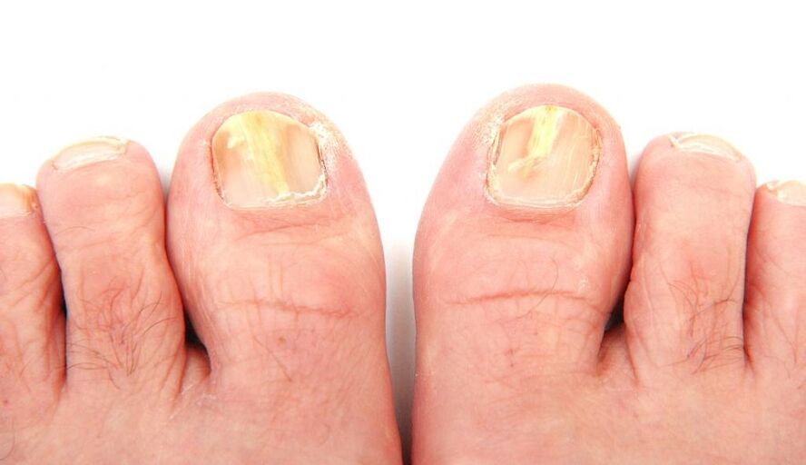 Fungus on toenails