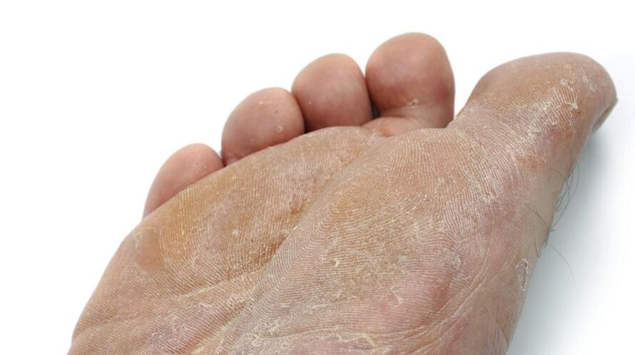 Symptoms of athlete's foot