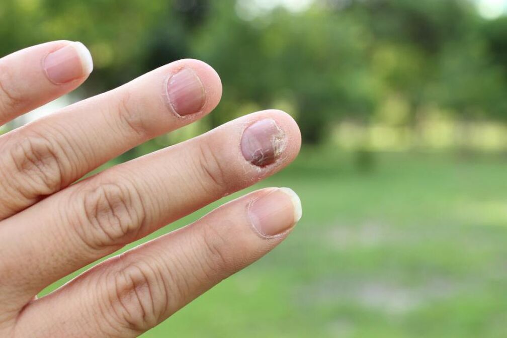 Fingernail fungus