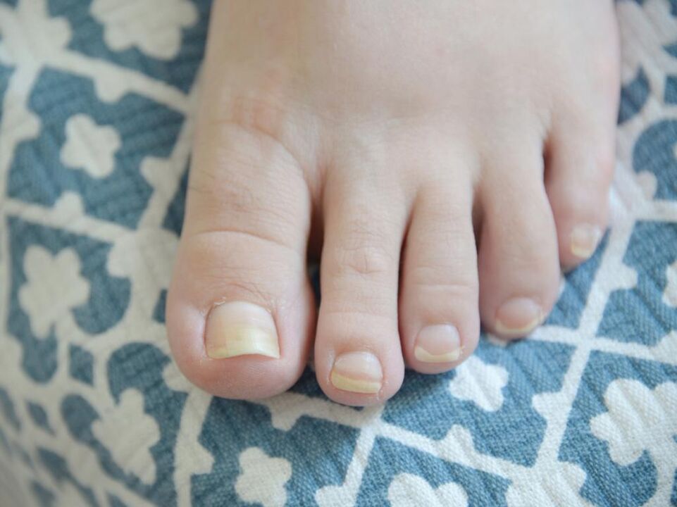Fungus on toenails