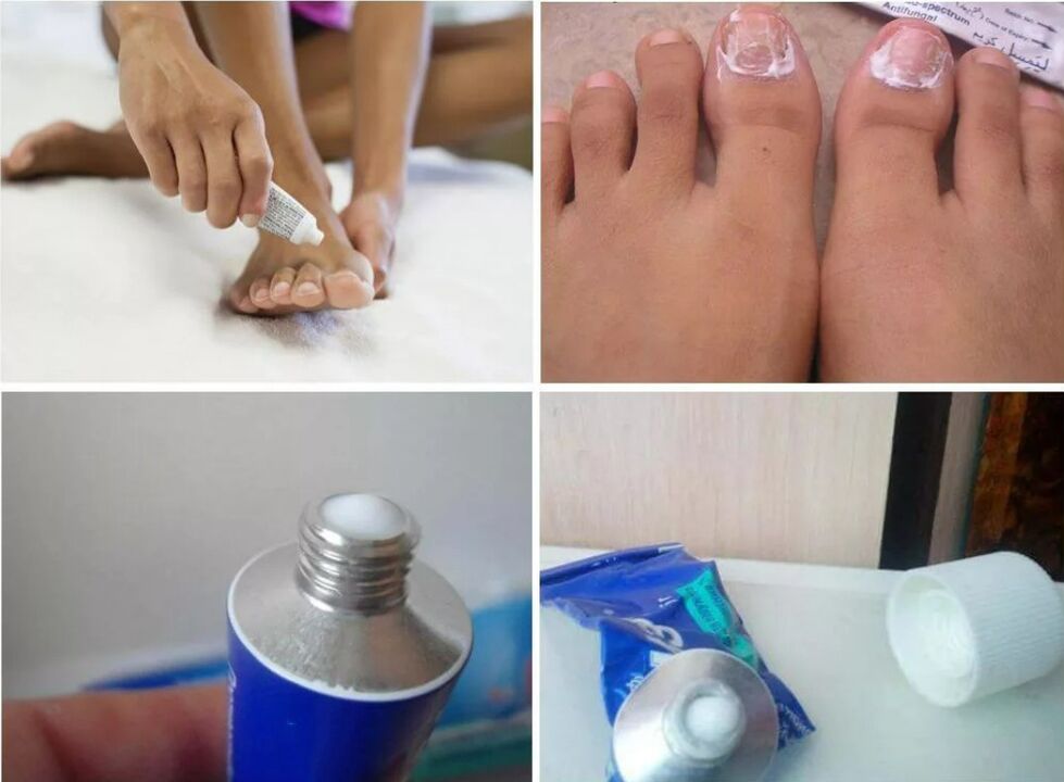 Medicines for toenail fungus