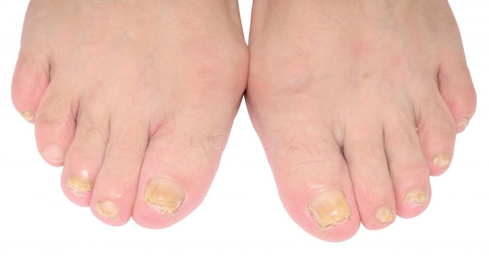 Signs of toenail fungus