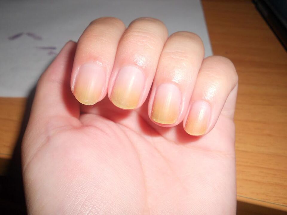Symptoms of fingernail fungus