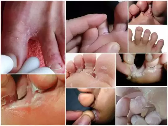 Symptoms of a fungus between the toes, photo 2