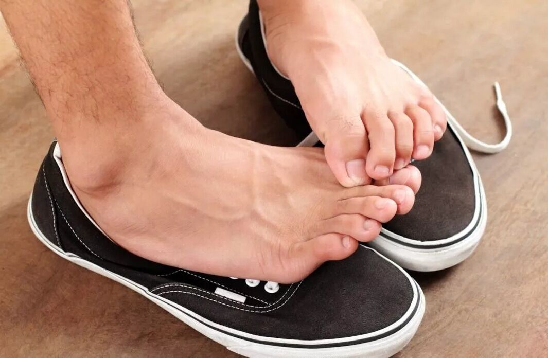 Itching in the feet due to a fungus between the toes