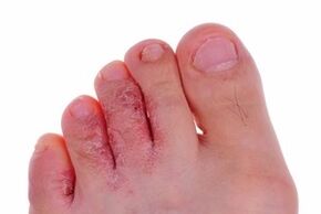 Skin lesions caused by fungi on the legs