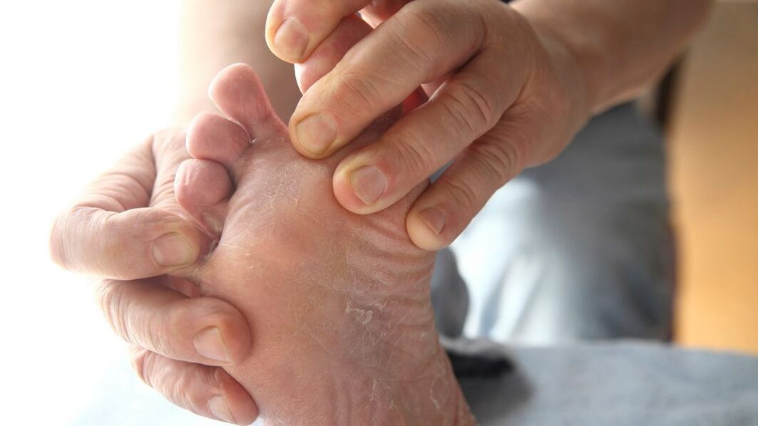 Symptoms of athlete's foot