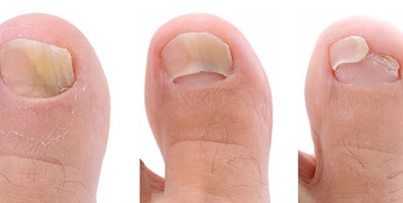 Photo of toenail fungus