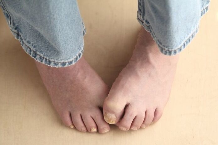 Feet with fungal nails