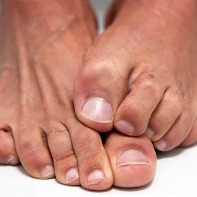 Fungus on the feet can cause itching