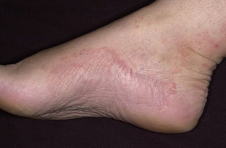 Athlete's foot infection