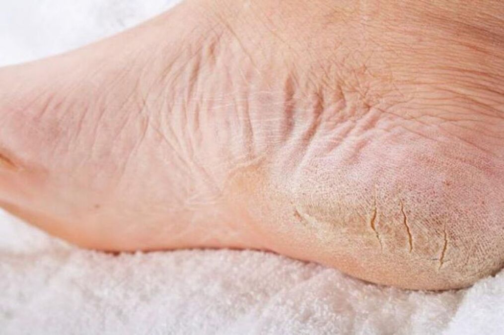 Cracked heels are a sign of athlete's foot