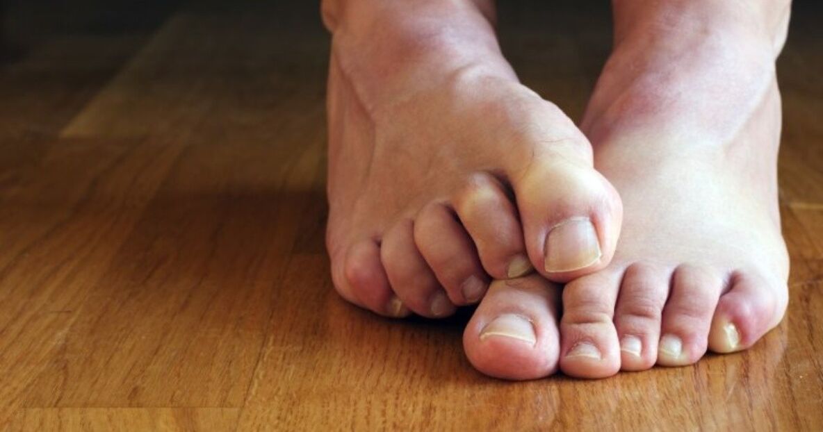 Symptoms of a fungus between the toes